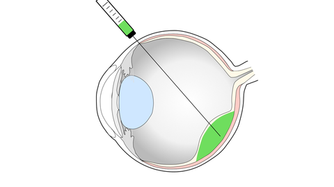 RPE Transplant