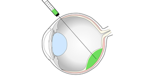 RPE Transplant