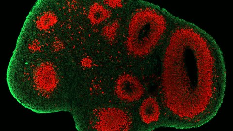 Cerebral organoids as new models to study human neurogenesis. The generation of human brain organoids from induced pluripotent stem cells enables the investigation of human neural progenitor cells (SOX2/red) and neurons (TUJ1/green)