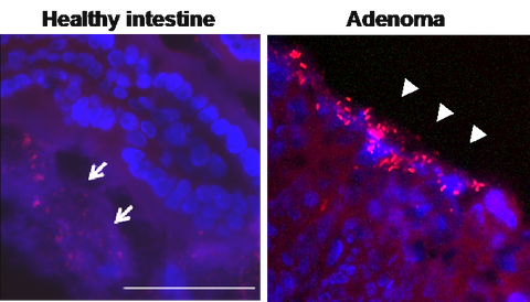 Bacterial infiltration (red) into host tissue in intestinal adenomas (Peuker et al., Nat. Med. 2016).