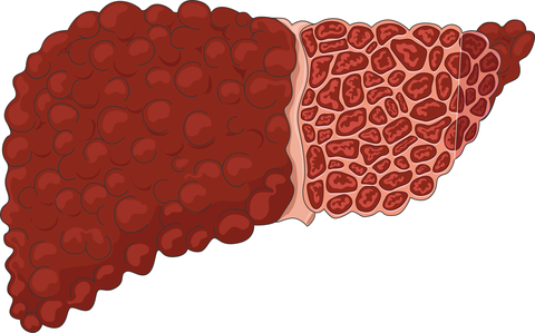 Zirrhose