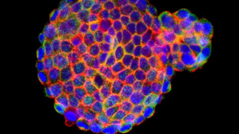 Depicted is a immunofluorescently labeled patient-derived tumor organoid. These cellular models recapitulate the molecular characteristics of a patient’s tumor and can be used to test treatment response. 