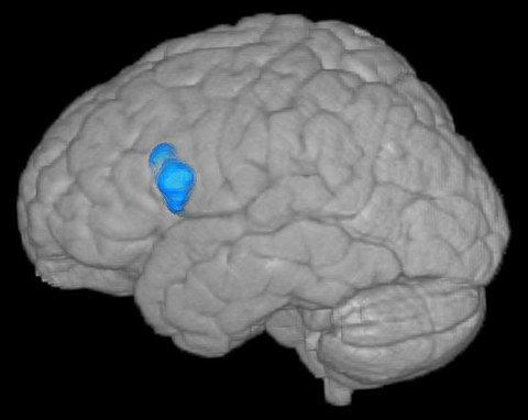 MRT: Lage Hirntumor