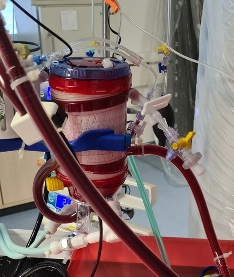 Oxygenator im ECMO-Kreislauf