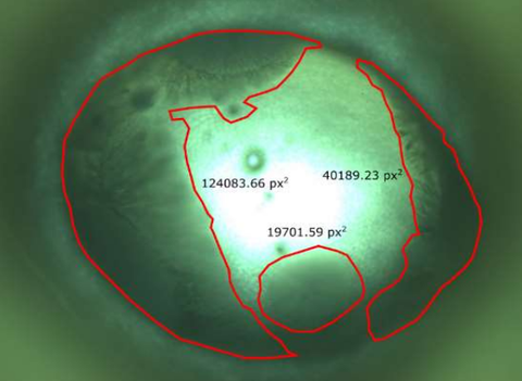 Mikroskopaufnahme der Kristallisation eines Salzes mit markierten bereits erstarrten Flächen