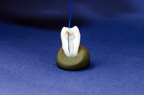 Halbschnitt eines humanen Zahnes mit in den Wurzelkanal eingeführter GFK-Instrumentenspitze.