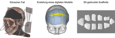 Von links nach rechts sind zu sehen: Ein Schädel mit Schädeldefekten (fehlender Knochen), ein digitales Modell des Schädels mit modellierten Implantaten, 3D gedruckte Scaffolds (Implantate)