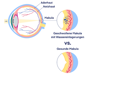 2_Auge-mit-DMOe_vs_ohne_web