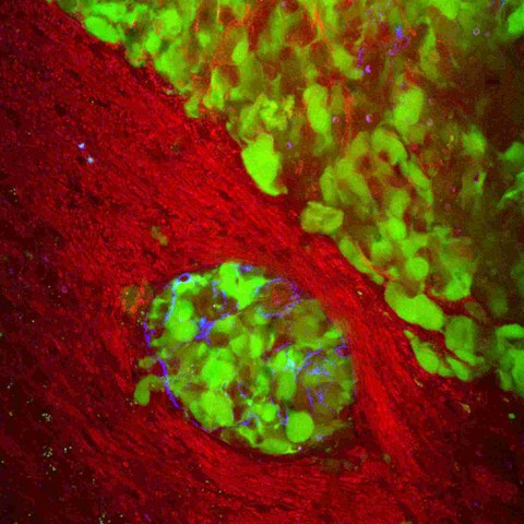 Grünfluoreszierend Tumorzellen in Maushirn