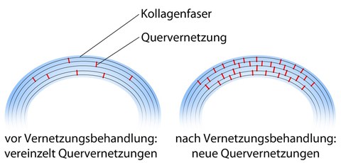 Vernetzung Hornhaut