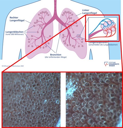 Das Bild zeigt eine schematische Darstellung der beiden Lungenflügel inklusive zwei Aufnahmen von Lungenbläschen