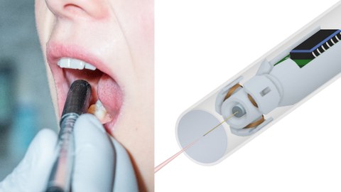 Das Bild zeigt einen offenen Mund, die Innenseite wird mit einem endoskopähnlichem Gerät untersucht.