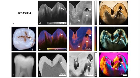 Das Bild zeigt verschiedene Aufnahmen eines Zahn mit optischer Kohärenztomografie.