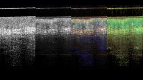 Das Bild zeigt eine OCT Aufnahme in verschiedenen Farbdarstellungen.