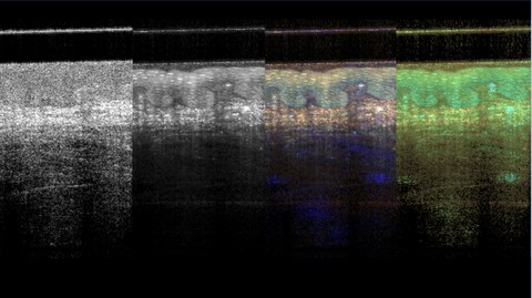 Das Bild zeigt eine OCT Aufnahme in verschiedenen Farbdarstellungen.