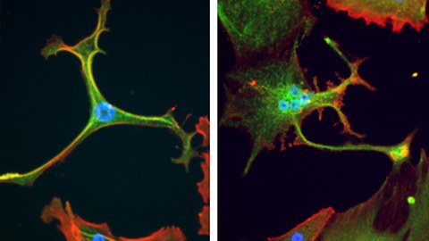 Sarkomkrebszellen in Kultur
