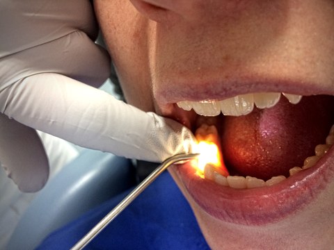 Fiberoptische Transillumination (FOTI) beim Zahn