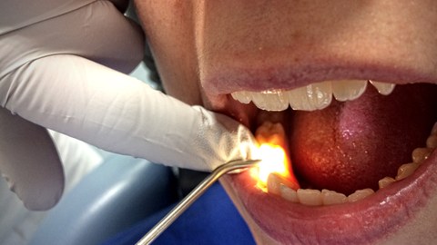 Fiberoptische Transillumination (FOTI) beim Zahn