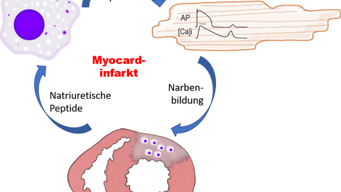 Myocardial Infarction