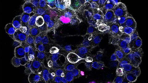 Patientenspezifisches Modell der menschlichen Leber zur Erforschung von Krankheiten