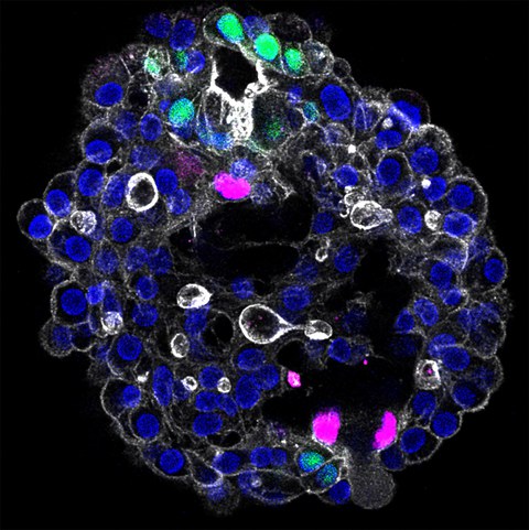 Patient-specific human liver model to understand disease mechanisms