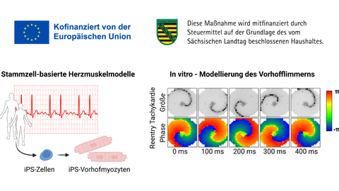 Links: Abbildung von aus iPS‑Zellen gewonnenen Vorhofmyozyten, die Veränderungen bei Vorhofflimmern darstellen. Rechts: Diagramm der elektrischen Aktivität der Zellen, das rhythmische Unregelmäßigkeiten in einem in‑vitro‑Modell von Vorhofflimmern zeigt.