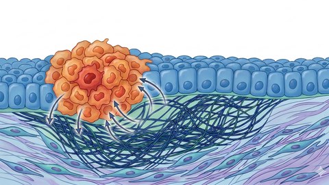 Schematic representation of a precancerous niche featuring a larger group of altered cells in the epithelium (upper layer) and bidirectional signaling to the underlying tissue.