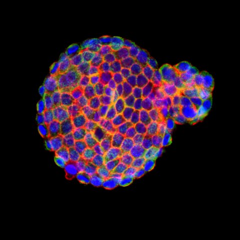 Depicted is a immunofluorescently labeled patient-derived tumor organoid. These cellular models recapitulate the molecular characteristics of a patient’s tumor and can be used to test treatment response.