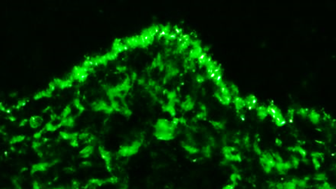 Ablagerungen von Immunkomplexen (grün) in der Haut eines Lupuspatienten TU Dresden