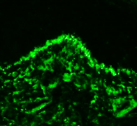 Ablagerungen von Immunkomplexen (grün) in der Haut eines Lupuspatienten TU Dresden
