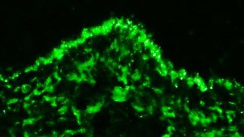 Ablagerungen von Immunkomplexen (grün) in der Haut eines Lupuspatienten TU Dresden