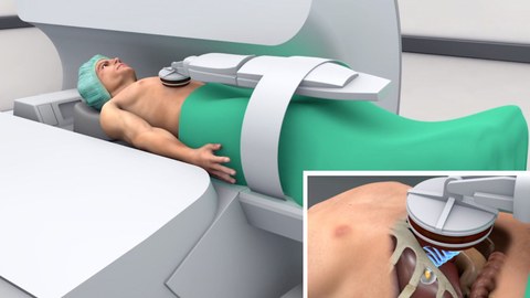 Anwendung des fokussierten Ultraschalls im MRT