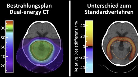 Durch die neuartige Bestrahlungsplanung auf Basis der Dual-Energy Computertomographie (links) lässt sich die Strahlendosis bei der Protonentherapie rings um den Tumor verringern (rechts)