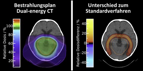 Durch die neuartige Bestrahlungsplanung auf Basis der Dual-Energy Computertomographie (links) lässt sich die Strahlendosis bei der Protonentherapie rings um den Tumor verringern (rechts)