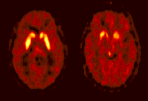 Normalbefund vs. Parkinson