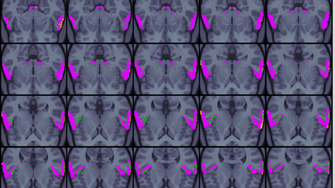 Zu sehen sind viele Schichtaufnahmen eines Gehirns neben- und untereinander