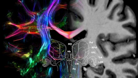 Farbig kenntlich gemachte Hirnstrukturen