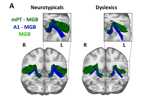 Die Abbildung zeigt in Grün die Faserverbindungen zwischen dem Planum Temporale (mPT) und dem auditorischen Thalamus (MGB) bei Kontrollprobanden (links) und bei Leuten mit Lese-Rechtschreib-Schwäche (LRS). In der linken Hemisphäre (mit L gekennzeichnet) i