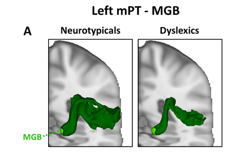 Die Abbildung zeigt in Grün die Faserverbindungen zwischen dem Planum Temporale (mPT) und dem auditorischen Thalamus (MGB) bei Kontrollprobanden und bei Leuten mit LRS in der linken Hemisphäre des Gehirns
