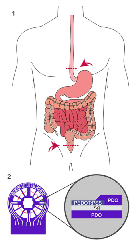 Schematische Darstellung von möglichen Positionen von Anastomosen im Dickdarm und in der Speiseröhre