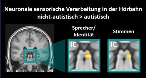 MRT-Aufnahmen eines Gehirns, links Gesamtbild, rechts zwei Ausschnitte eines austistischen und nichtautistischen Gehirns.