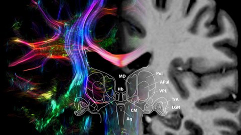Farbig kenntlich gemachte Hirnstrukturen