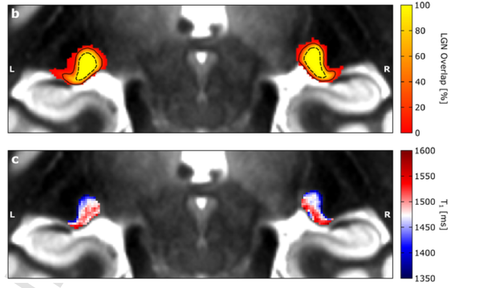 Das obere Feld zeigt die Lage des visuell-sensorischen Thalamus in den hochauflösenden MRT-Daten. Das untere Feld zeigt, dass Informationen über die Menge der weißen Substanz zur Unterscheidung des visuellen Thalamus verwendet werden können.