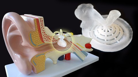 Modell eines Ohres, daneben ein Trommelfellimplantat aus weißem Kunststoff