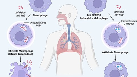 Grafik einer menschlichen Lunge, die den Verlauf einer Tuberkulose-Infektion zeigt.