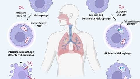 Grafik einer menschlichen Lunge, die den Verlauf einer Tuberkulose-Infektion zeigt.