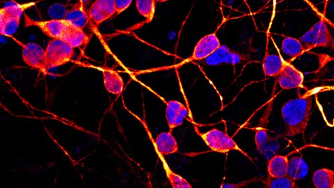 Zur Erforschung neurodegenerativer Erkrankungen wie ALS und Parkinson werden induzierte pluripotente Stammzellen (iPS-Zellen) genutzt.