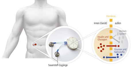 Grafik, auf der linken Seite ist ein Torso zu sehen, daneben in einem Kreis die Darstellung eines Reaktors für die Bauchspeicheldrüse, rechts daneben die mikroskopische Darstellung der Funktionsweise