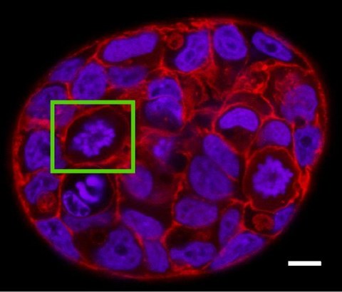 Mikroskopische Aufnahme einer Tumorzelle 