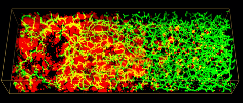 3D-Bild der Lipidtröpfchen (rot) und des Gallenkanalnetzwerks (grün) entlang der Leberläppchen eines Patienten mit nicht-alkoholischer Fettlebererkrankung (NAFLD). 